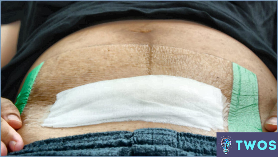 ¿Cómo limpiar la incisión de la abdominoplastia?